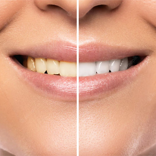 teeth-whitening-clinic